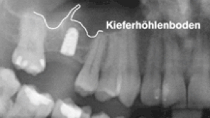 Röntgenbild Implantat: Künstliche Zahnwurzel