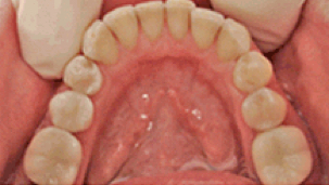 Fast unsichtbar: Zahnrestauration mit Vollkeramik